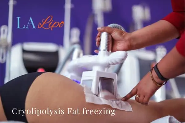 women getting fat freezing Greenwich