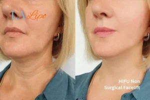 hi-fu for wrinkles Greenwich before and after results