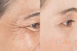 Before and after results of woman - HI-fu wrinkles reduction treatment Greenwich