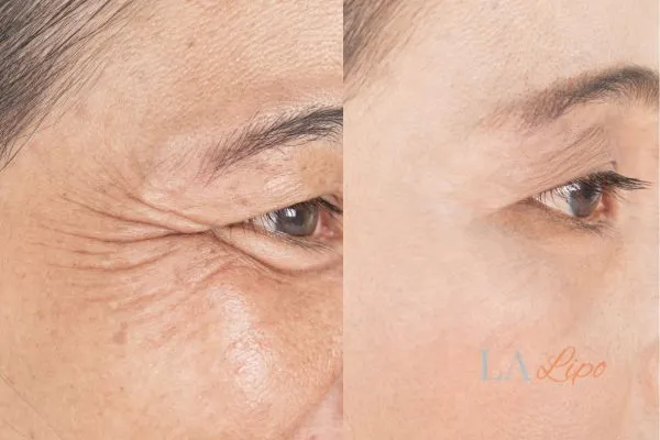 Before and after results of woman - HI-fu wrinkles reduction treatment Greenwich