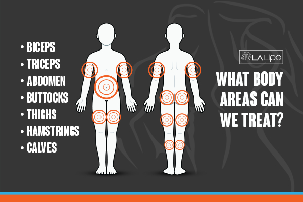 Graphic to show areas you can have LA-EMS Body Sculpting Greenwich treatment.