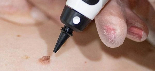 skin tag removal using cryopen Greenwich