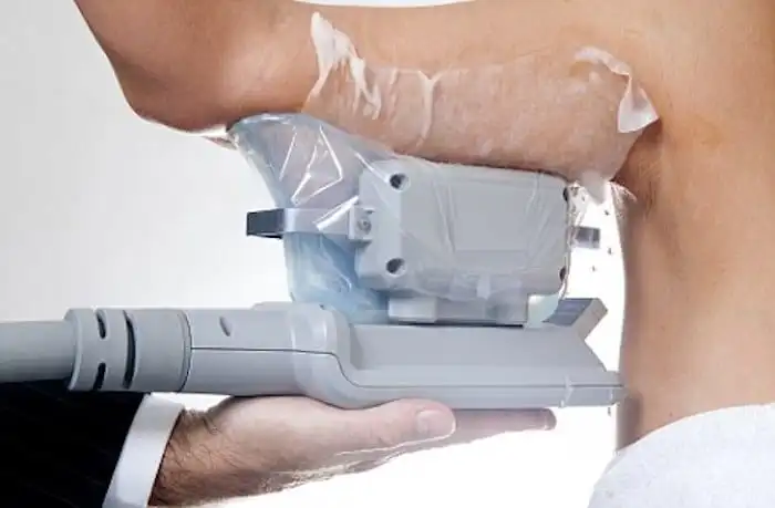 Picture of fat freezing Greenwich on the upper arms.
