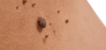 image of a skin tag Greenwich