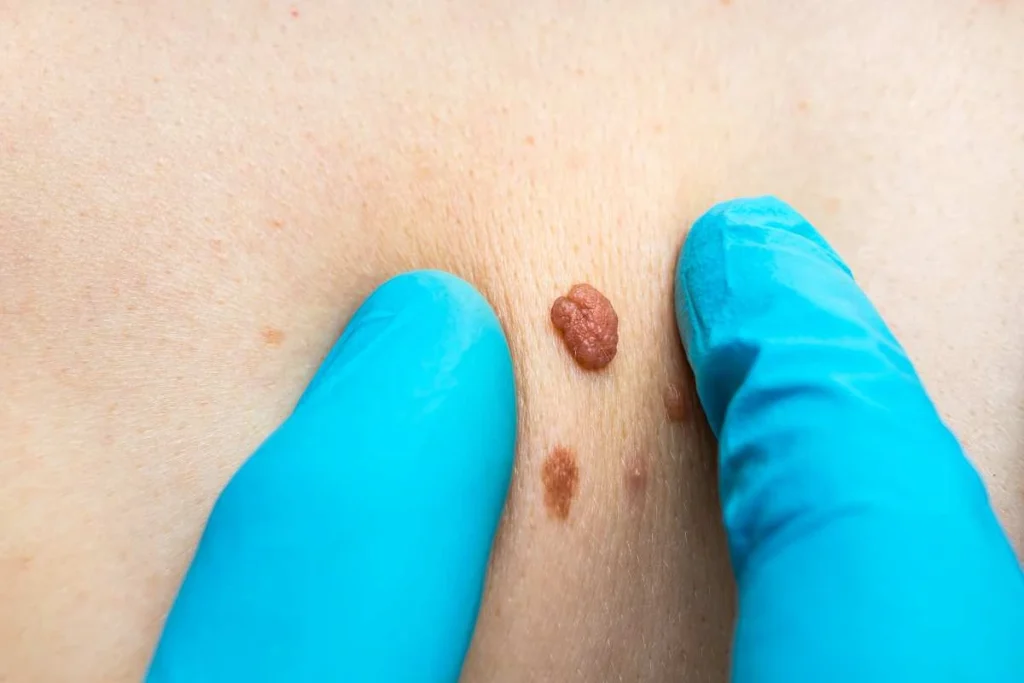 Consultant examining a skin tag Greenwich