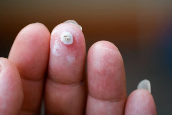 wart on person finger - cryotherapy to treat from LA LIPO Greenwich