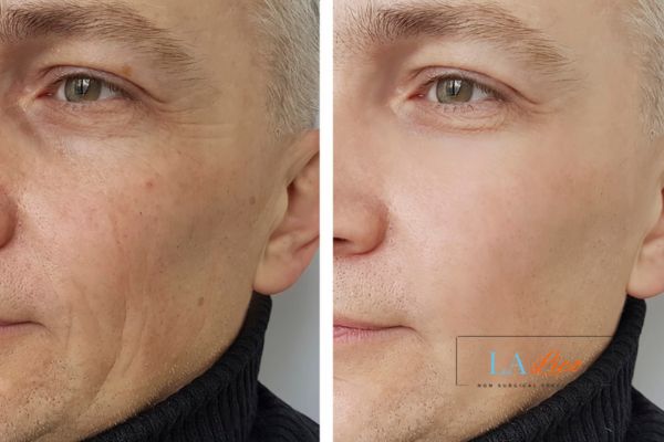 See the amazing results of Morpheus8 Treatment Greenwich!