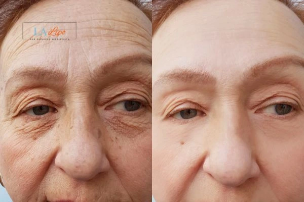 The powerful benefits of Morpheus8 Treatment Greenwich - Call Our team today!
