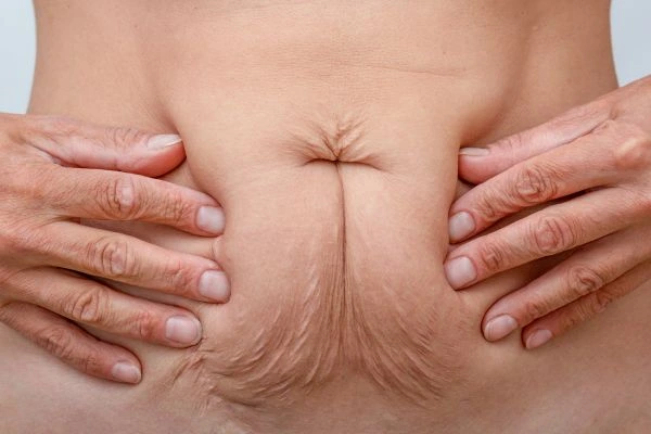 Should I Combine Diastasis Recti Treatment with Body Contouring for Better Results Greenwich?