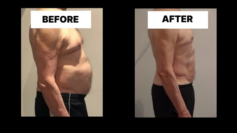 What Symptoms Can Diastasis Recti Cause in Men? Weak Core, Back Pain and Poor Posture Greenwich